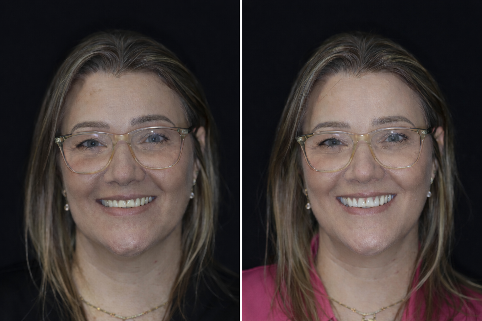 Antes e depois - facetas dentárias