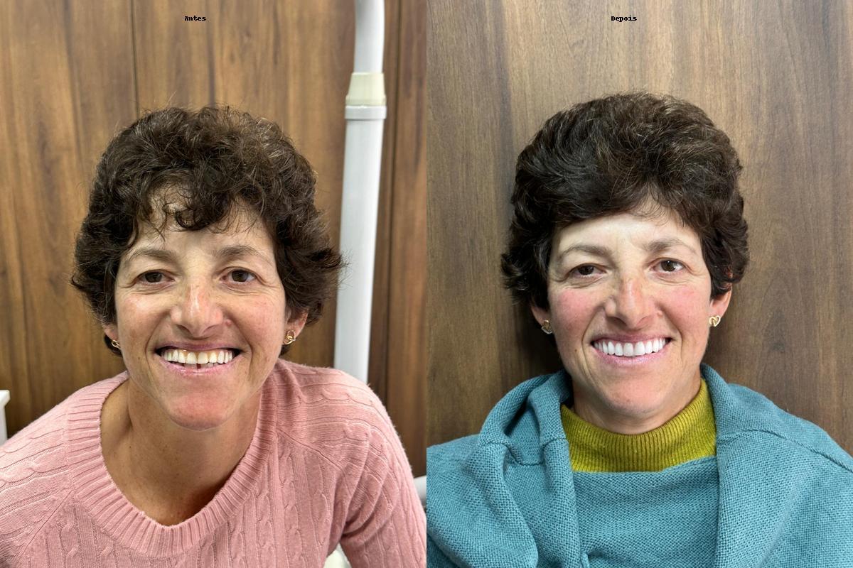 Antes e depois - reabilitação oral